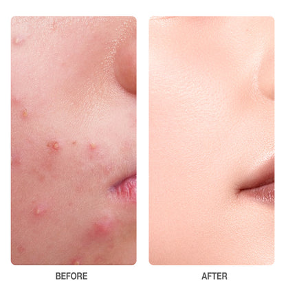 Skinever Salicylic Acid Acne Treatment Ice Sleep Mask